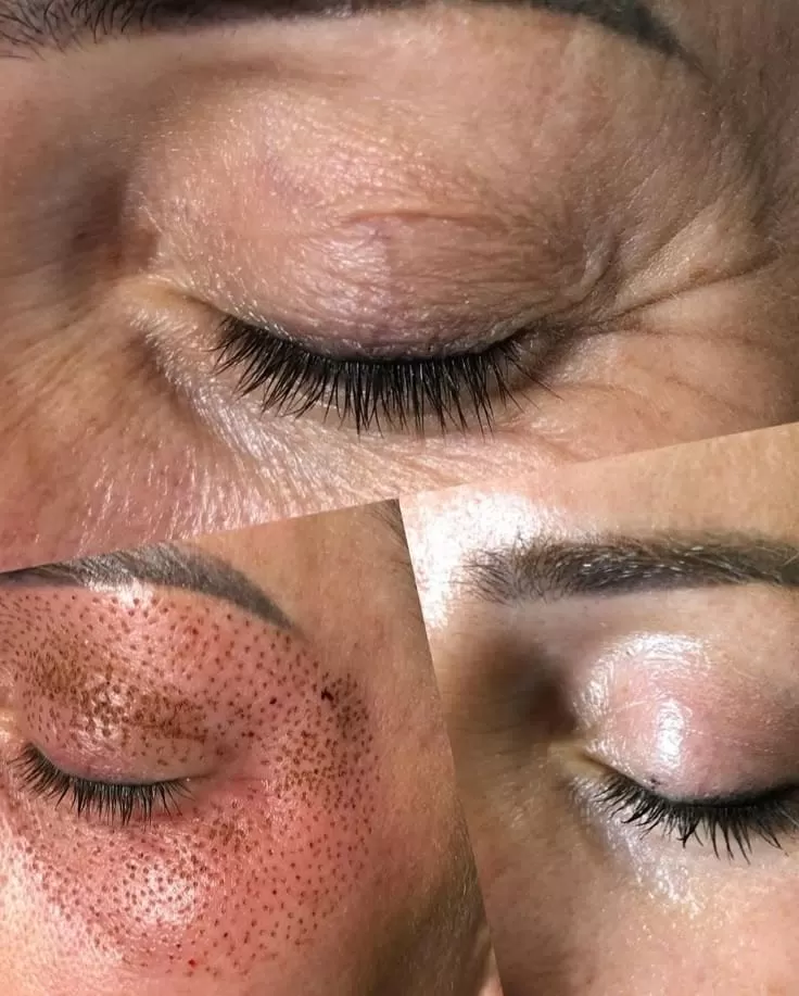 Lifting Lymphatic Drainage