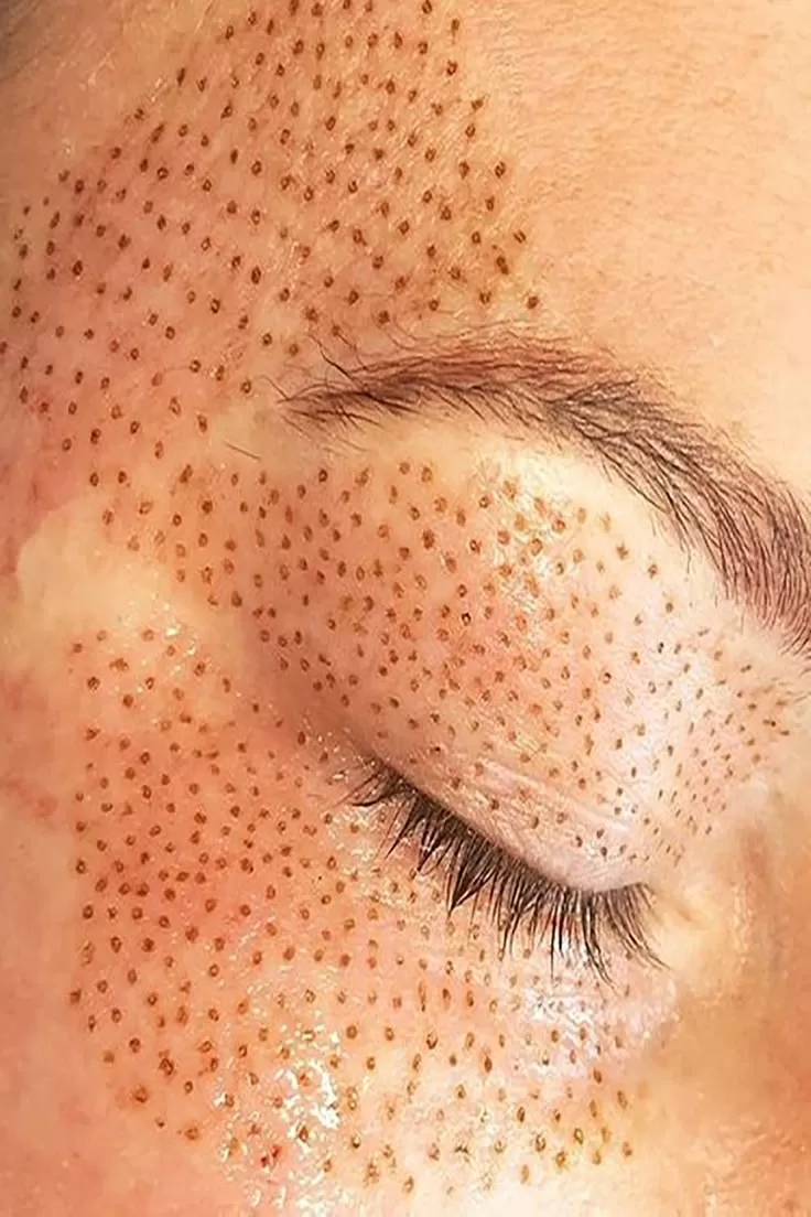 Lifting Lymphatic Drainage